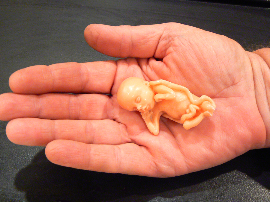 abortion 8 weeks. Photo Sources: quot;9 week fetusquot;
